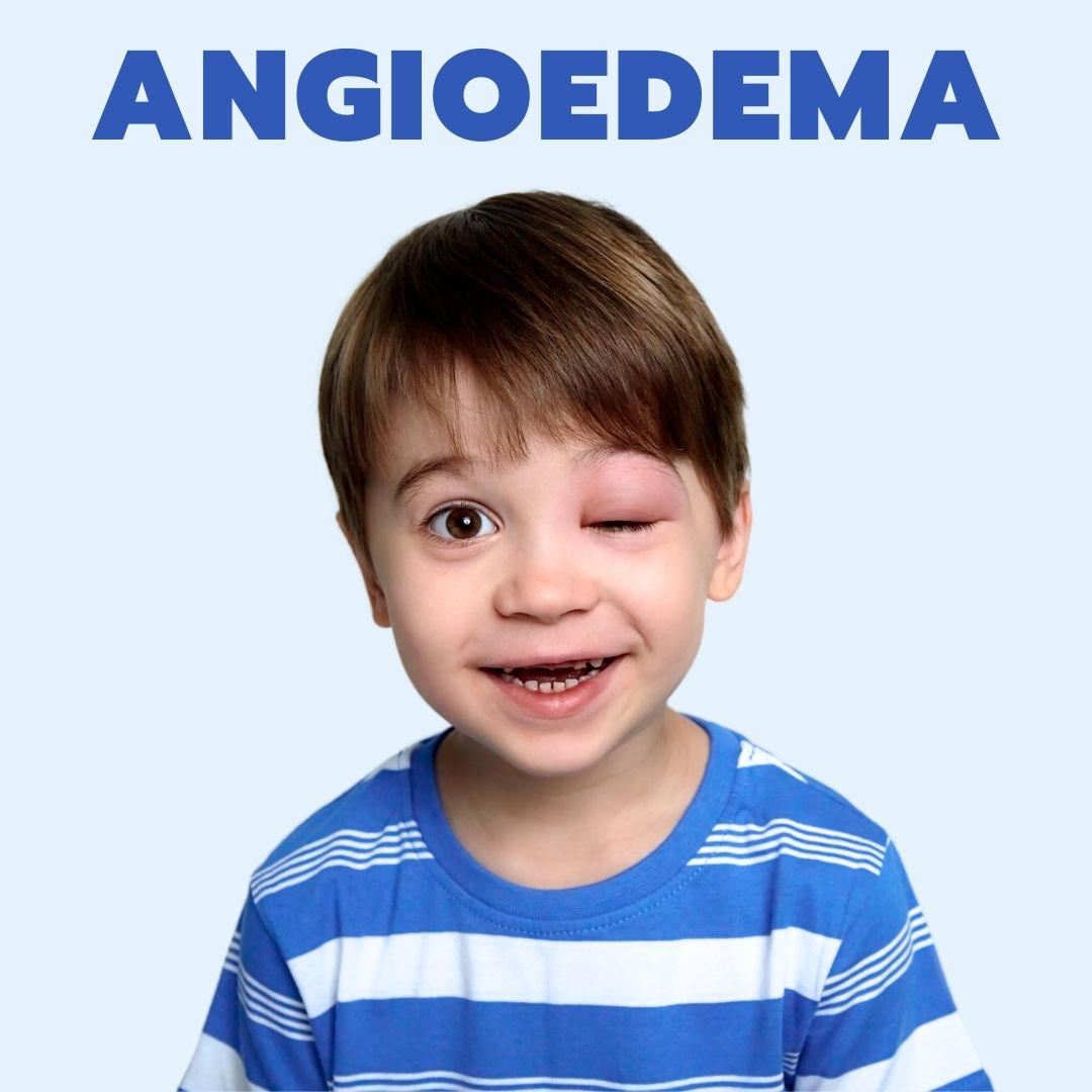 Angioedema