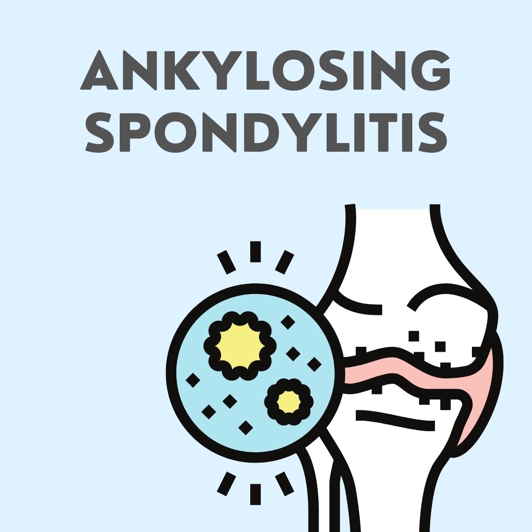 Ankylosing Spondylitis