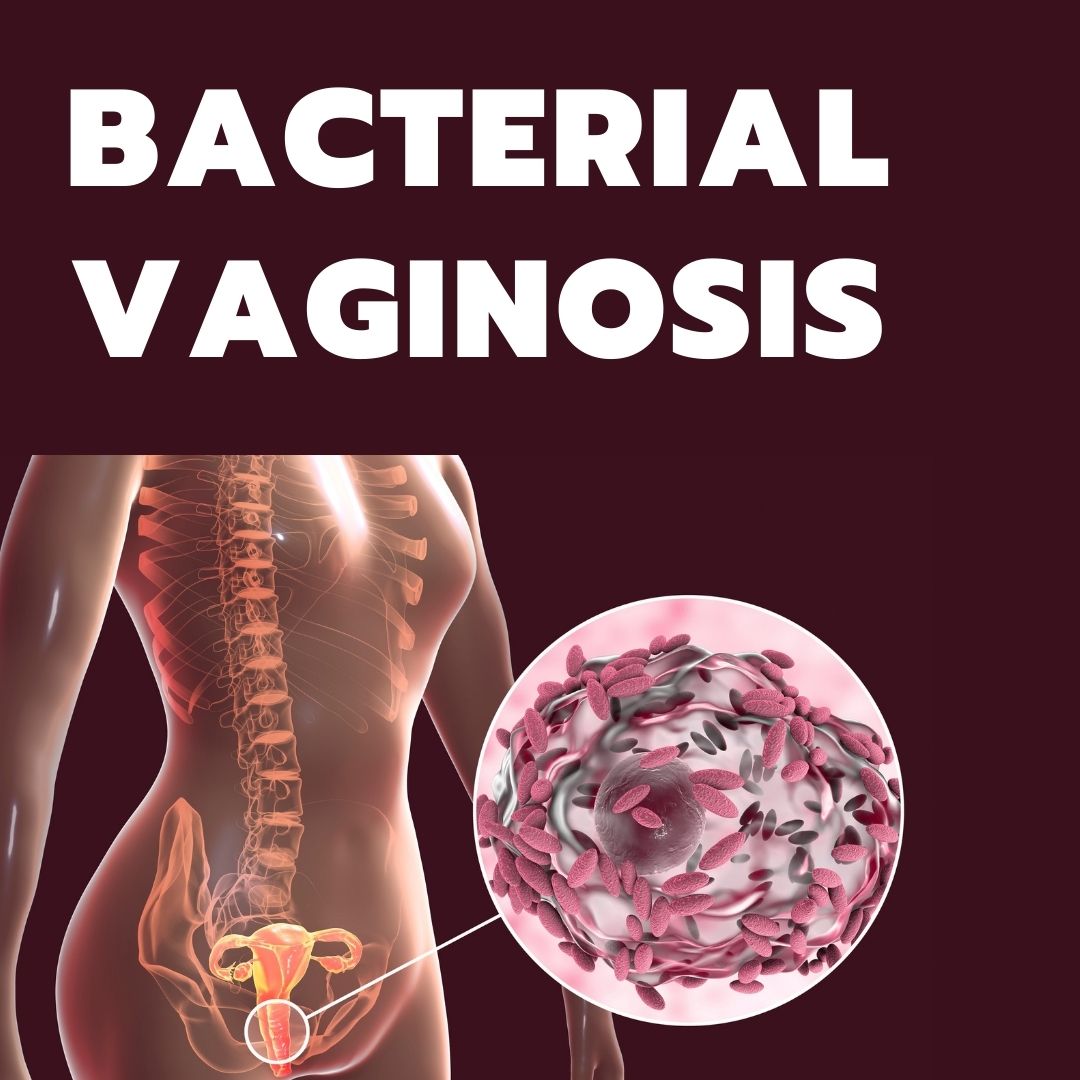 Bacterial Vaginosis