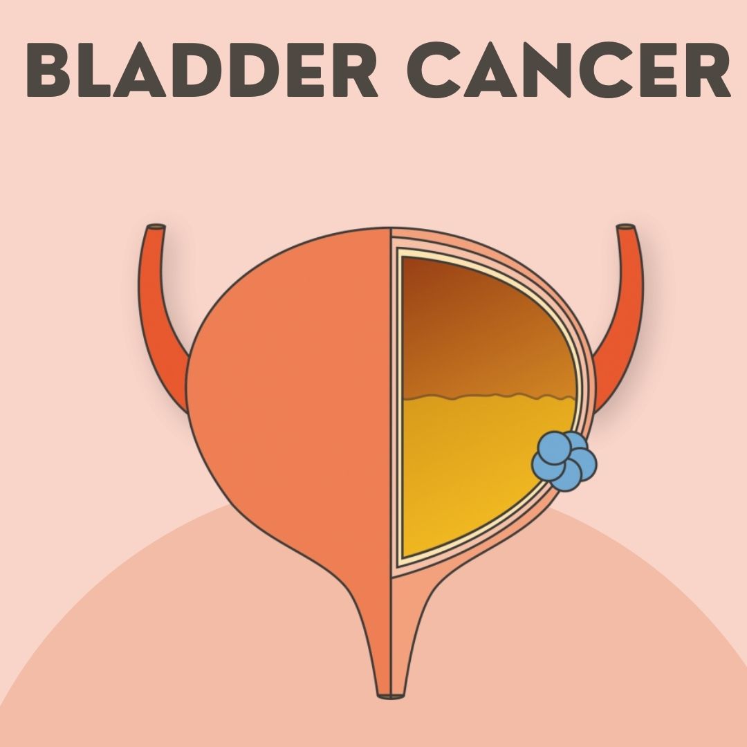 Bladder Cancer