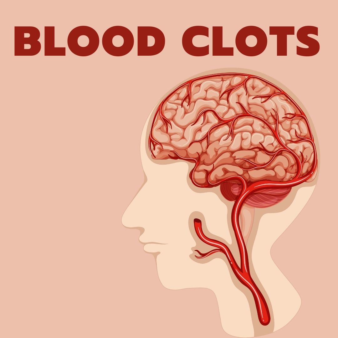 Blood Clots