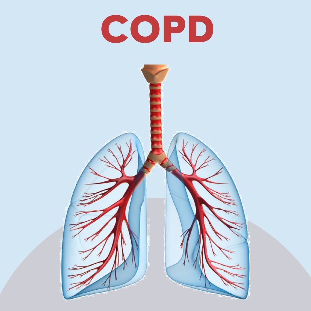 COPD