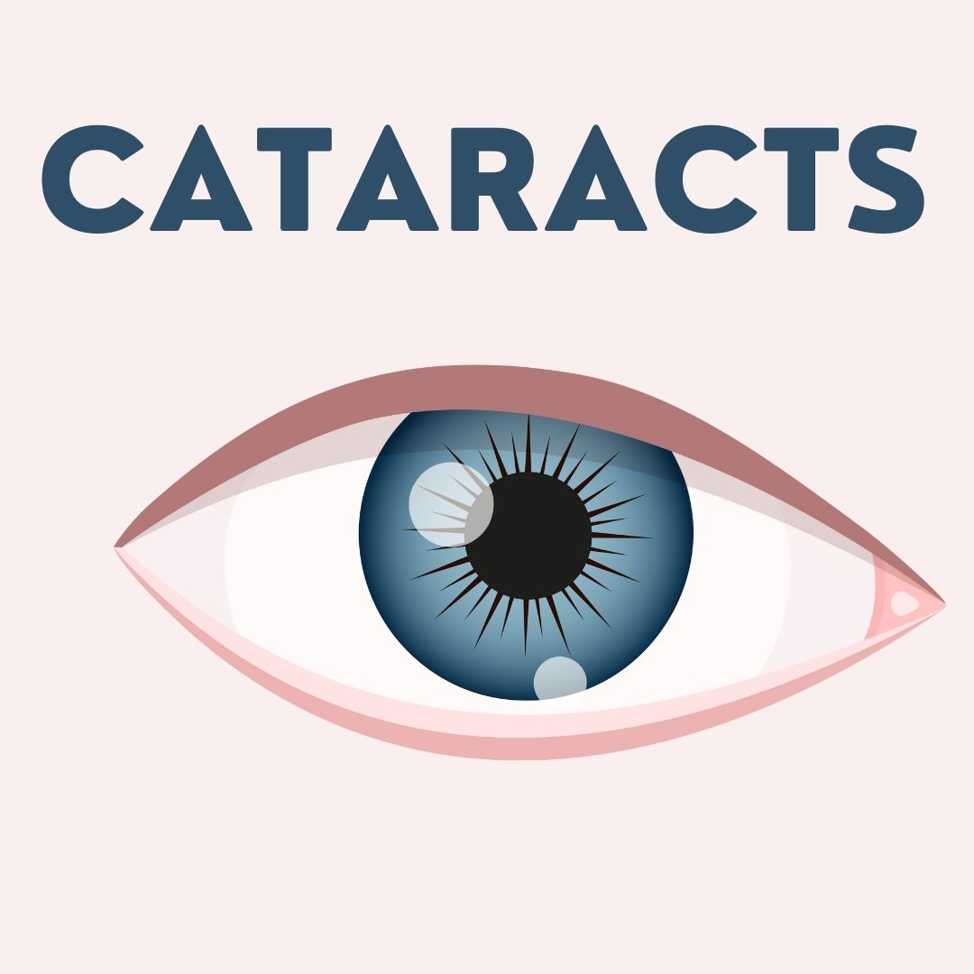 Cataracts