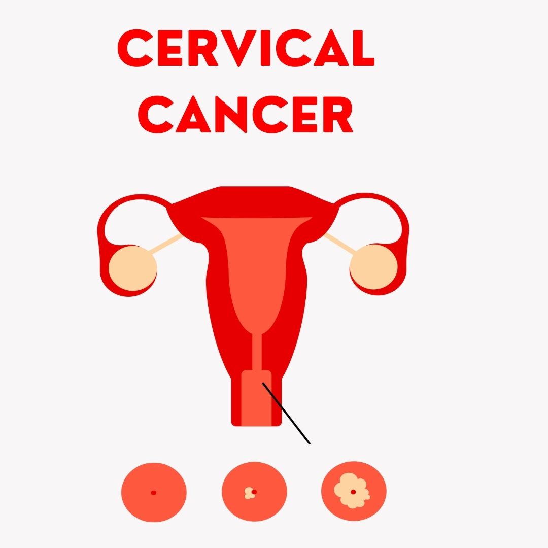 Cervical Cancer