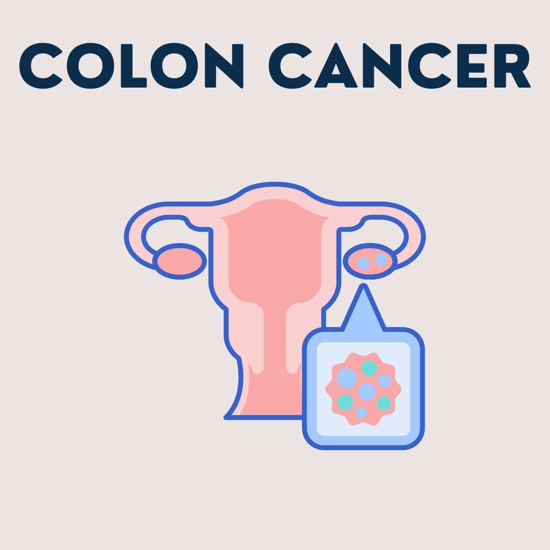 Colon Cancer