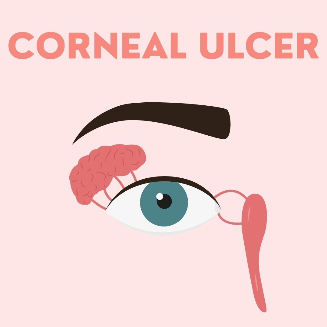 Corneal Ulcer