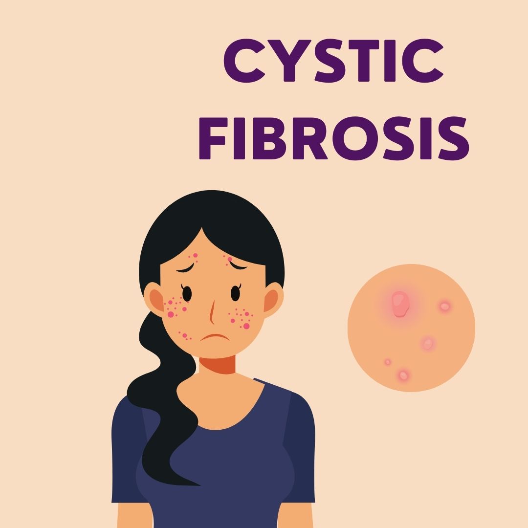 Cystic Fibrosis