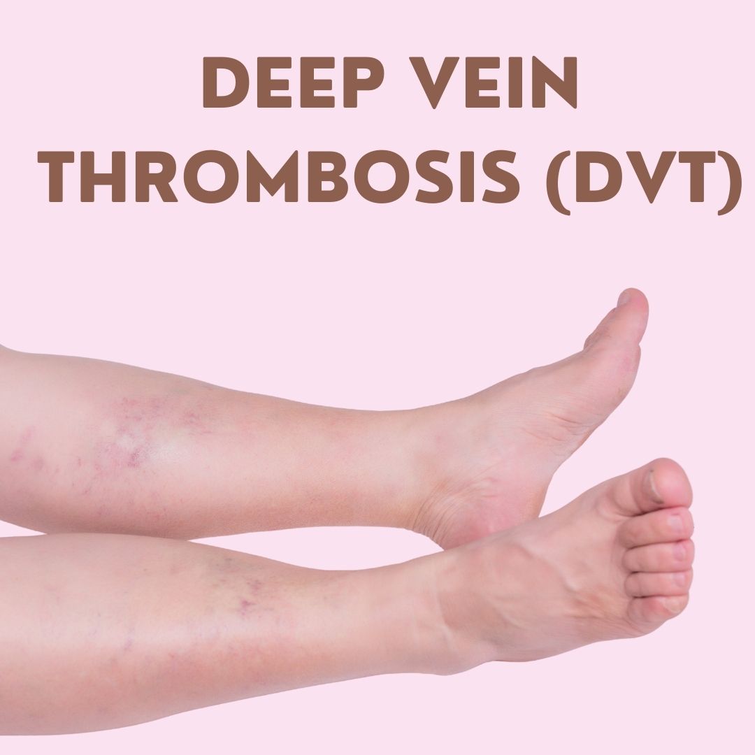 Deep Vein Thrombosis (DVT)