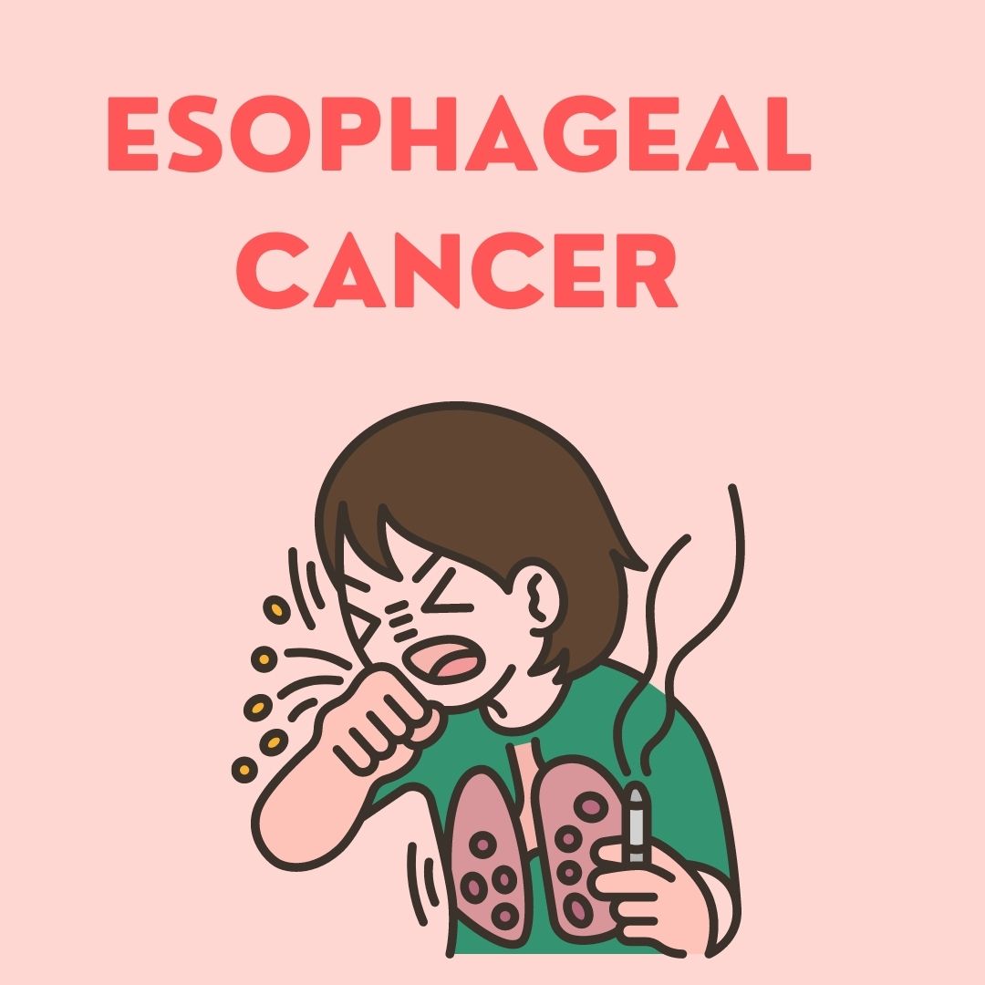 Esophageal Cancer