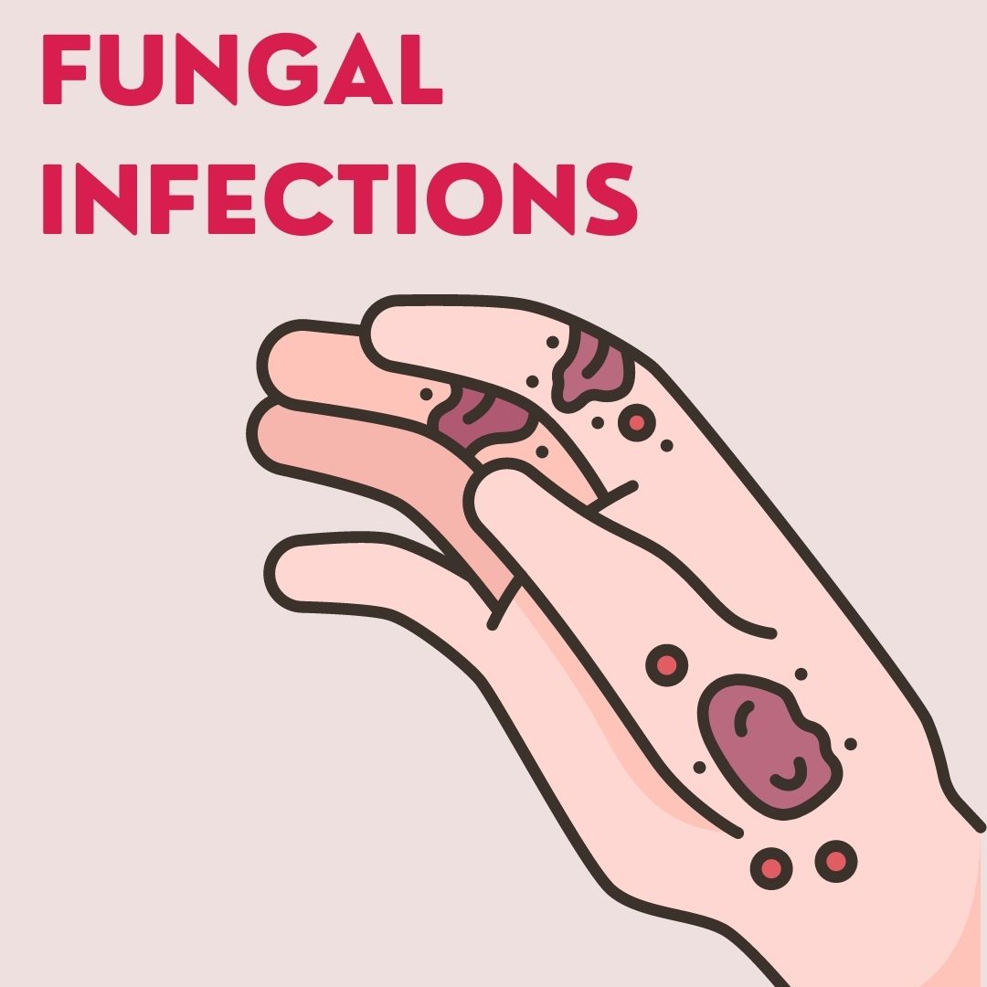 Fungal Infections