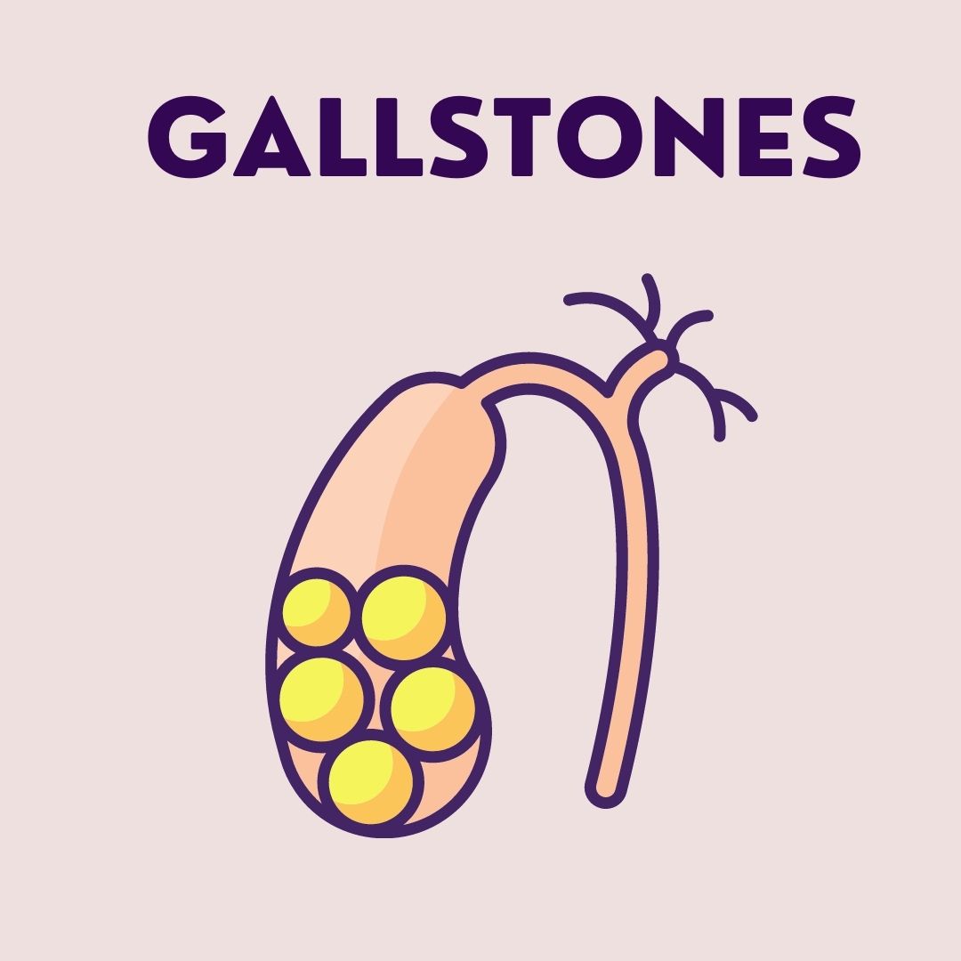 Gallstones