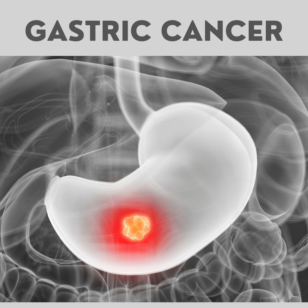 Gastric Cancer