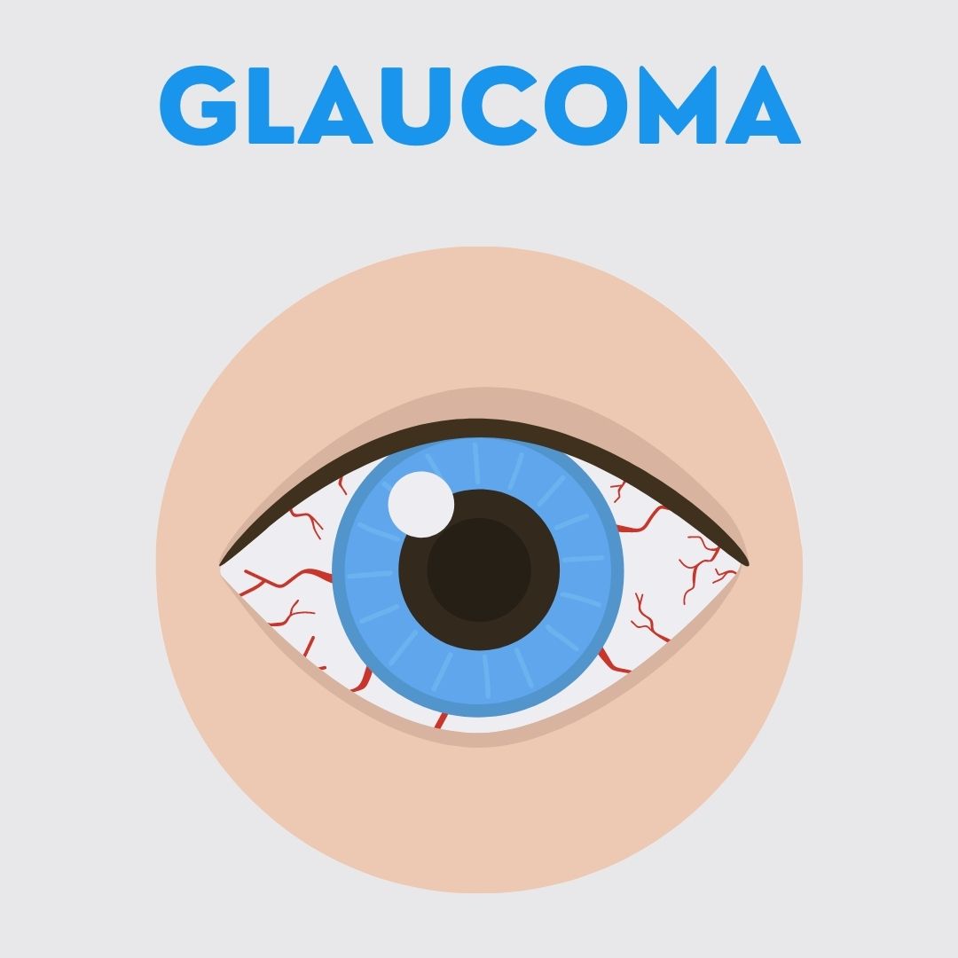 Glaucoma