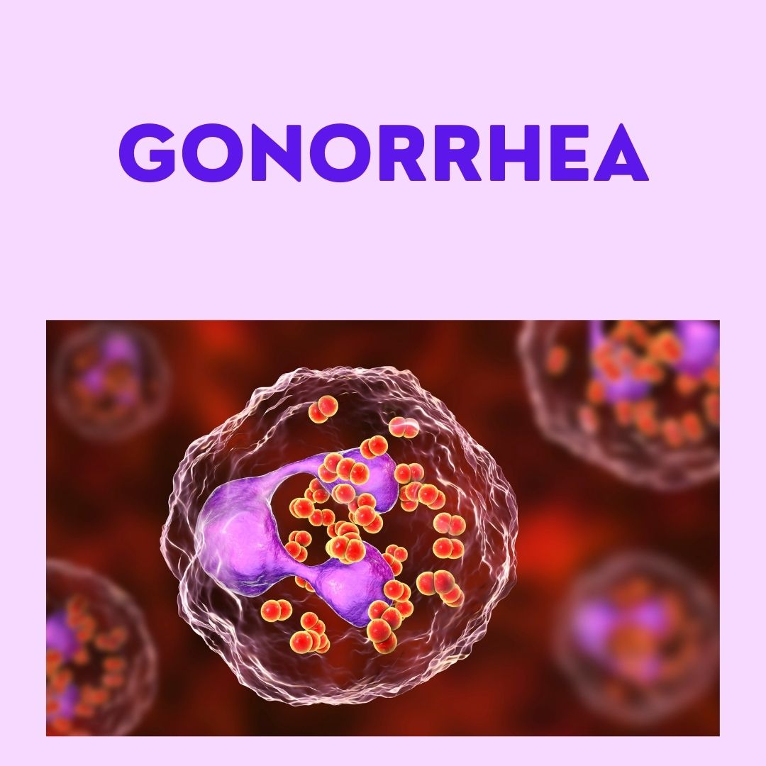 Gonorrhea