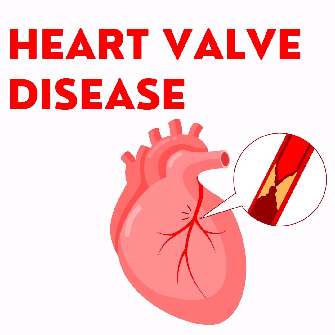 Heart Valve Disease