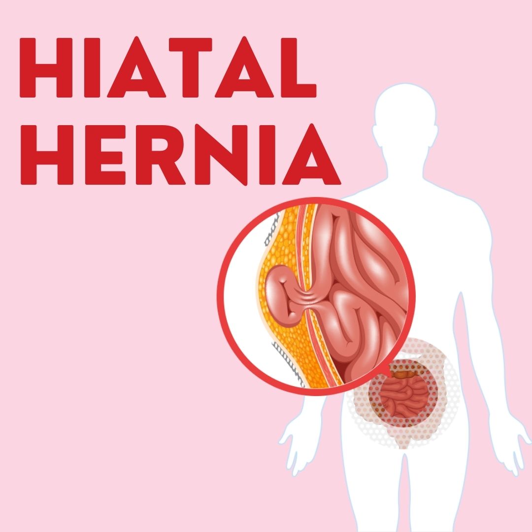 Hiatal Hernia