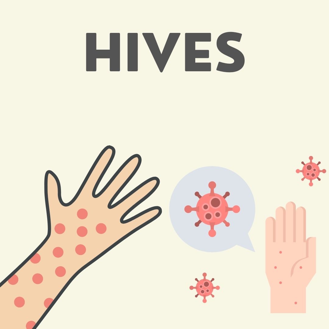 Hives