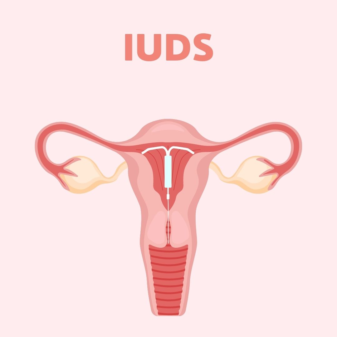 IUDs