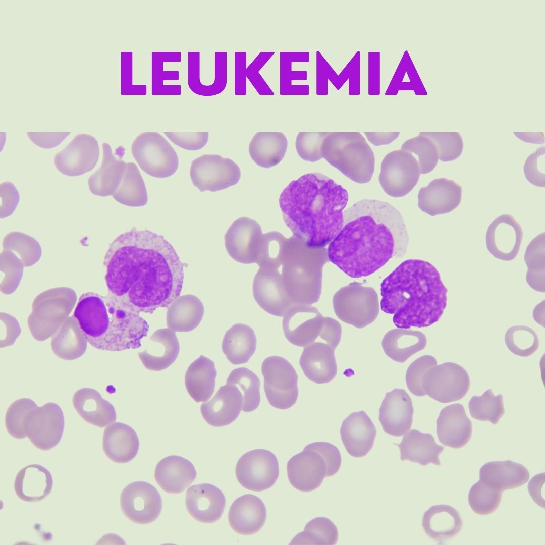 Leukemia