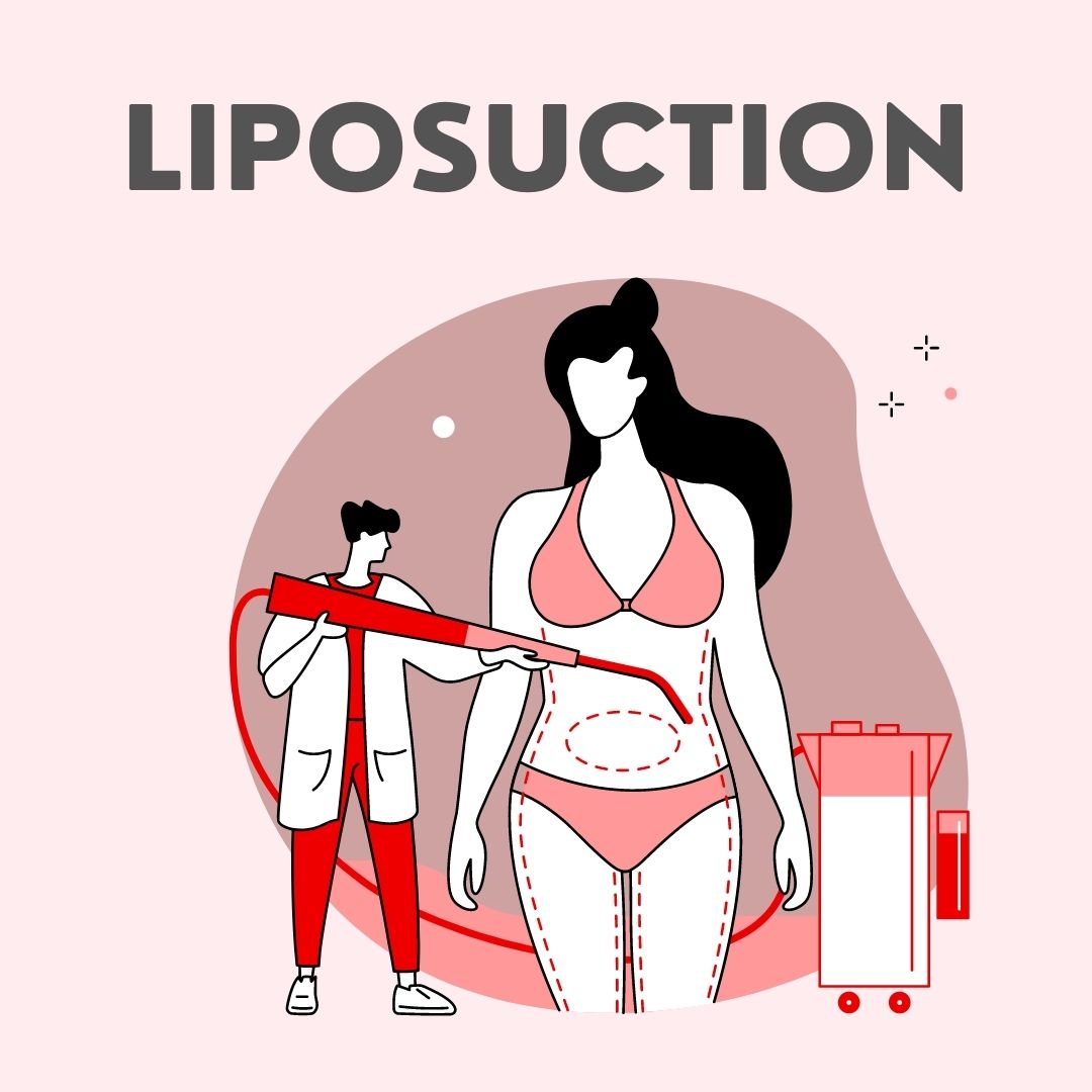 Liposuction