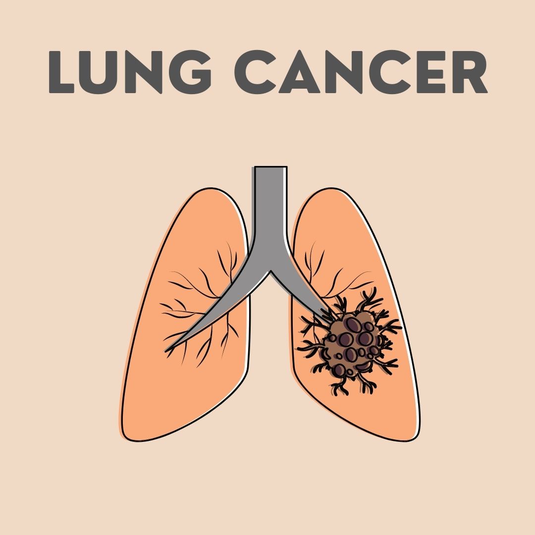 Lung Cancer