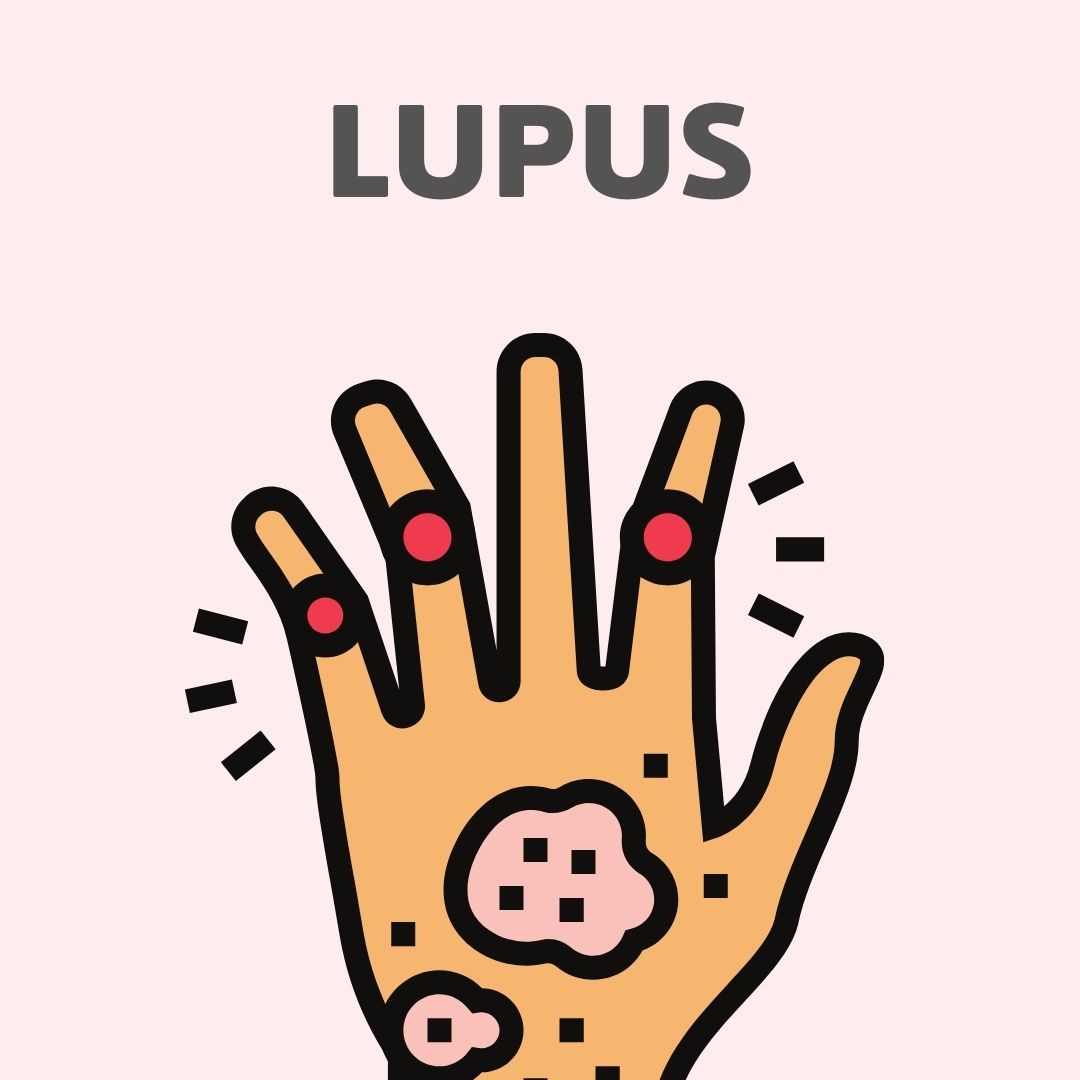 Lupus