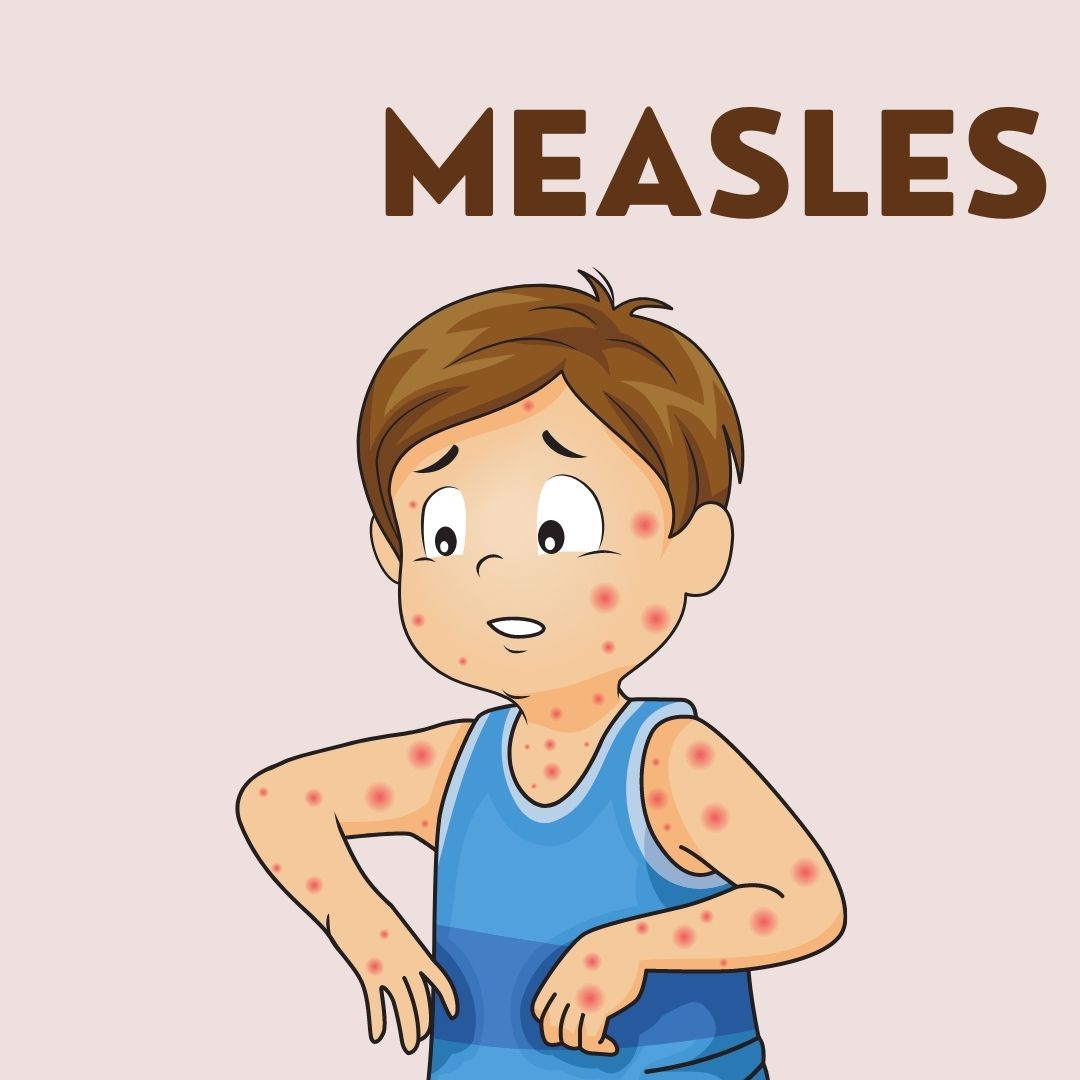 Measles