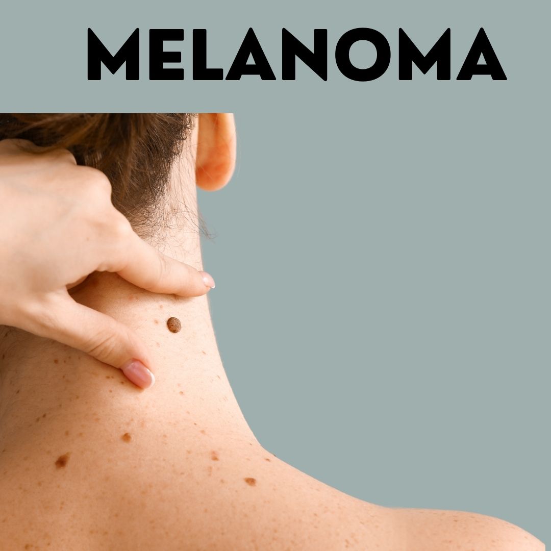 Melanoma