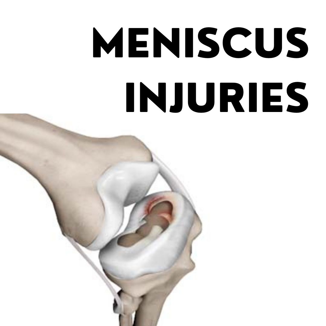 Meniscus Injuries