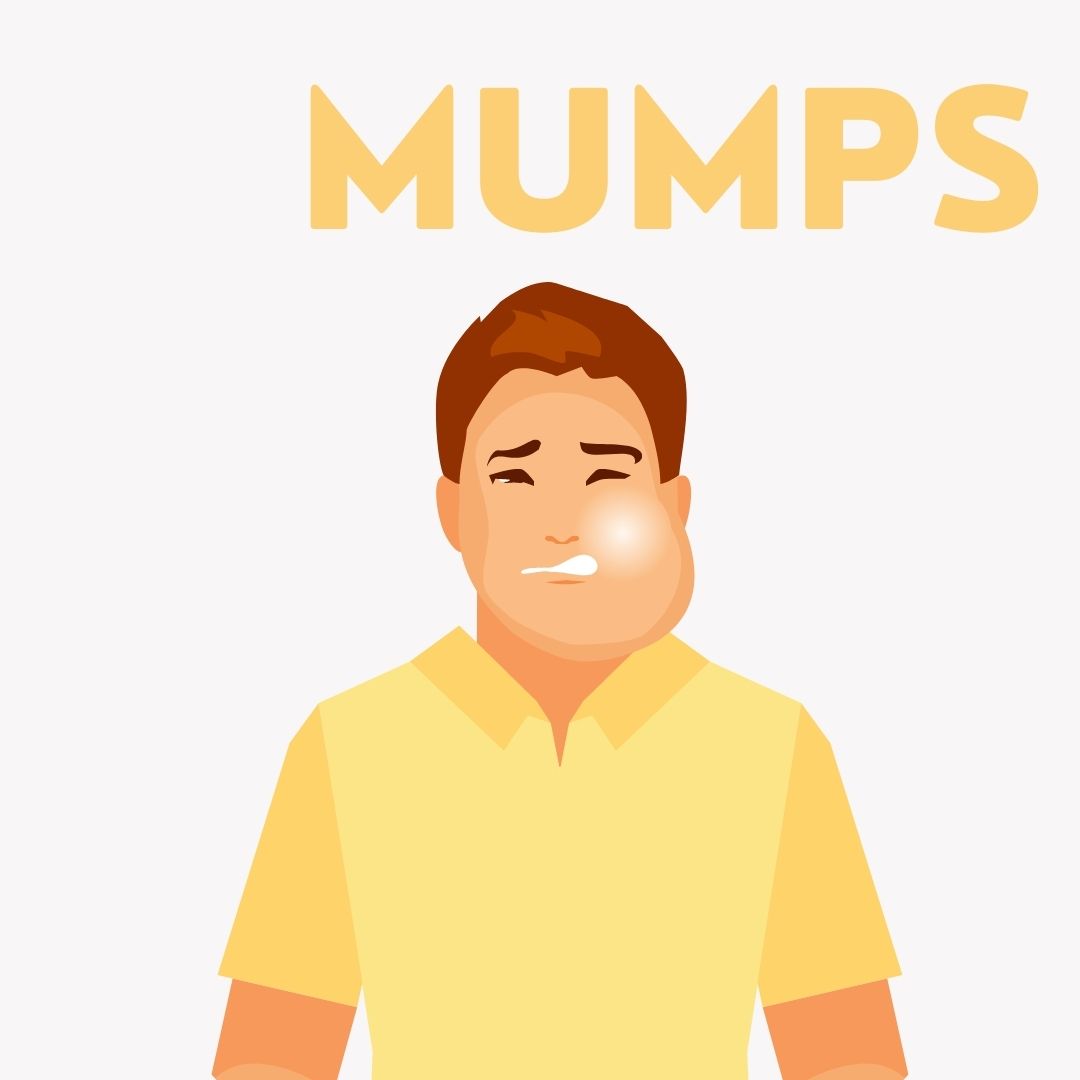 Mumps