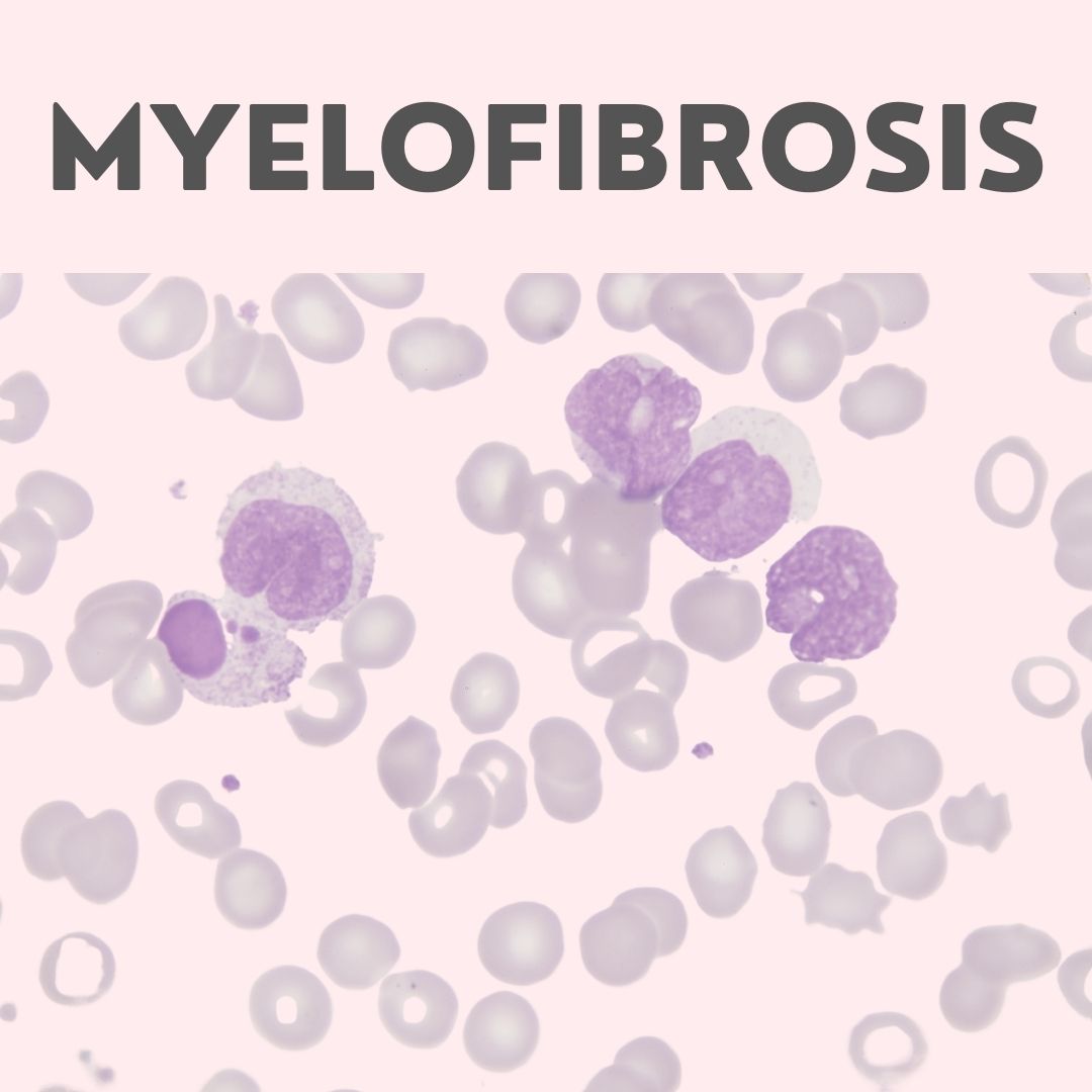 Myelofibrosis