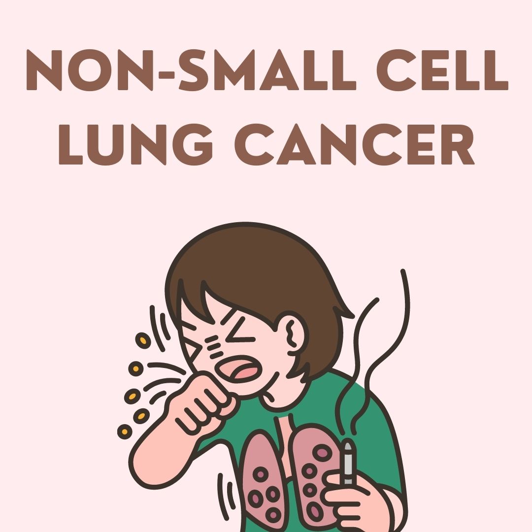 Non-Small Cell Lung Cancer