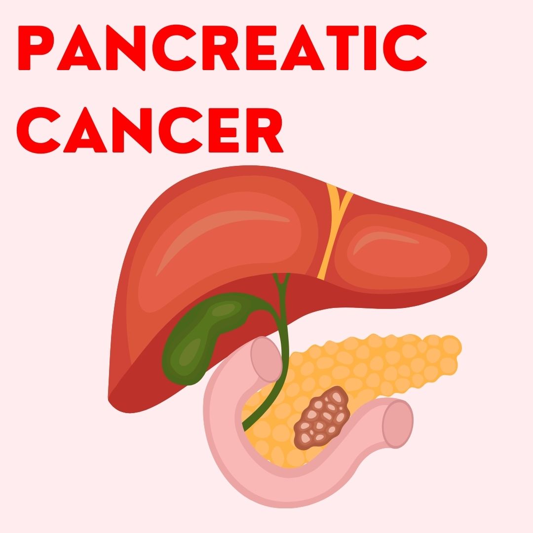 Pancreatic Cancer