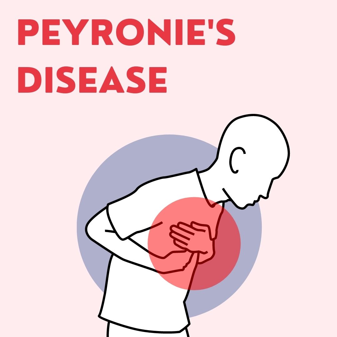 Peyronie's Disease