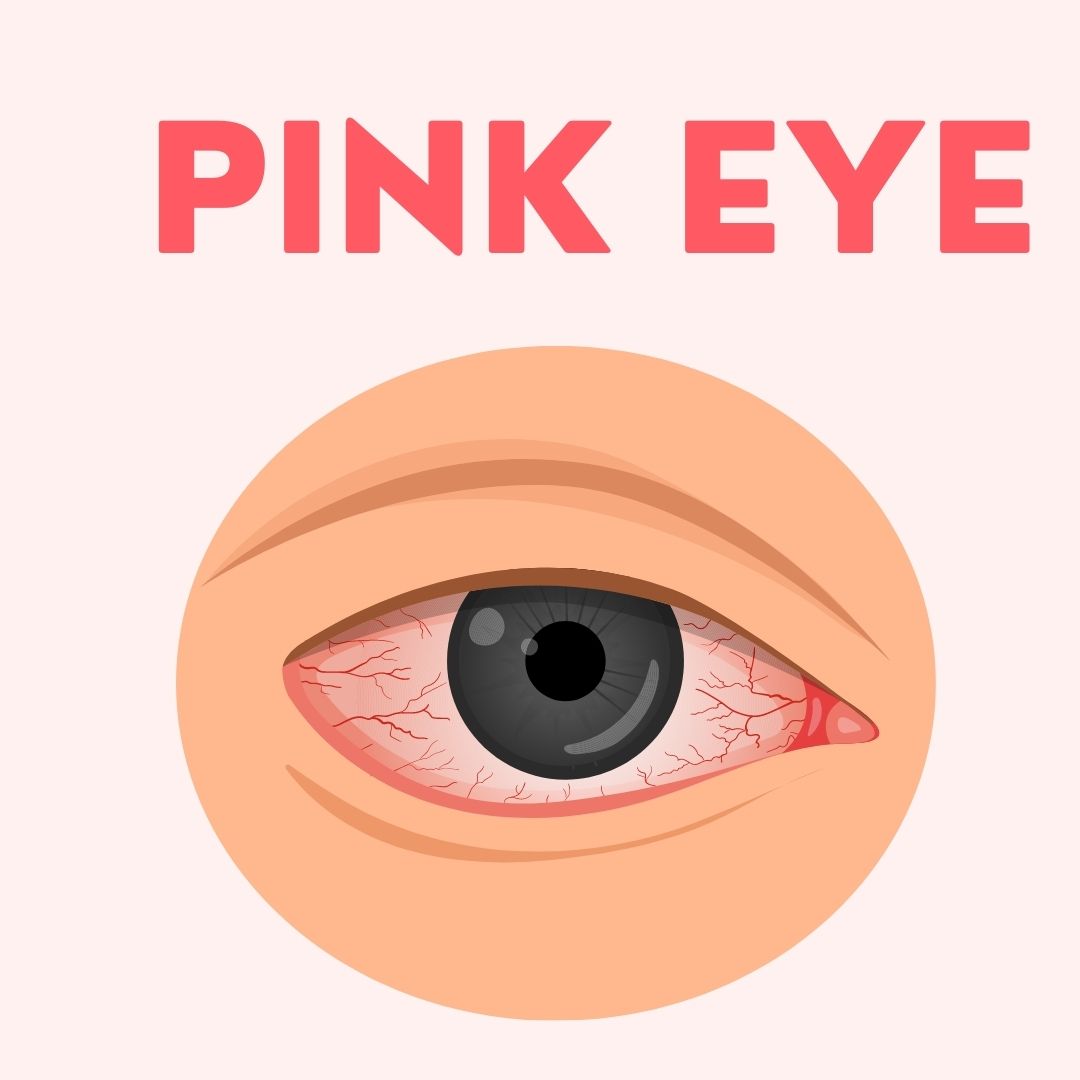 Pink Eye