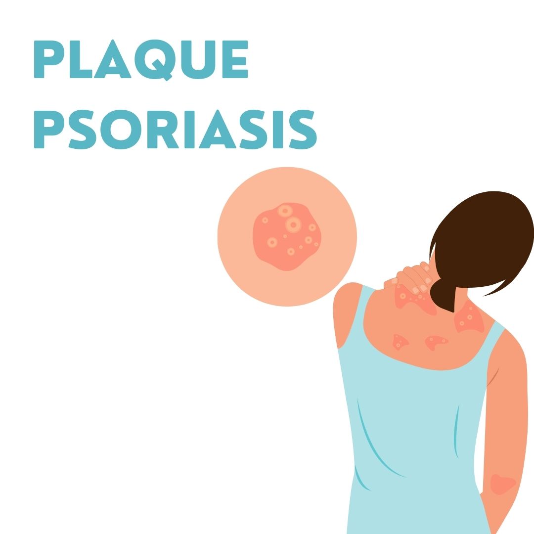 Plaque Psoriasis