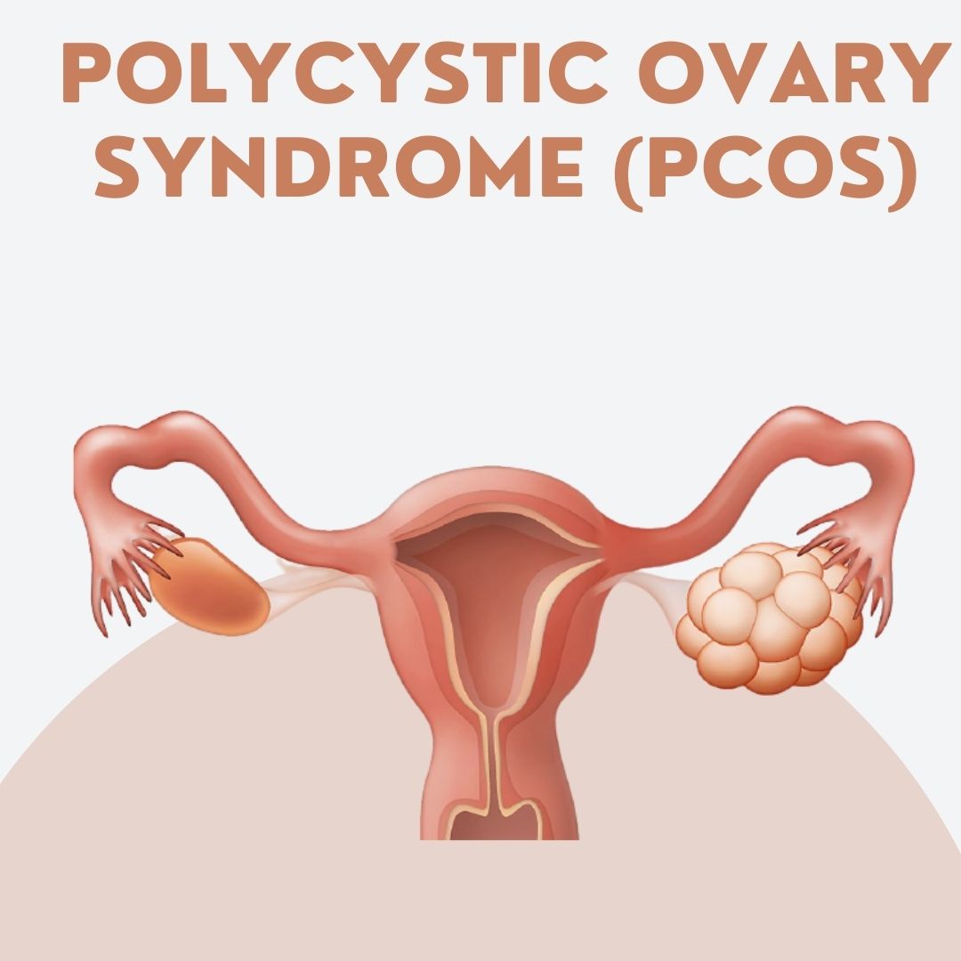 PCOS