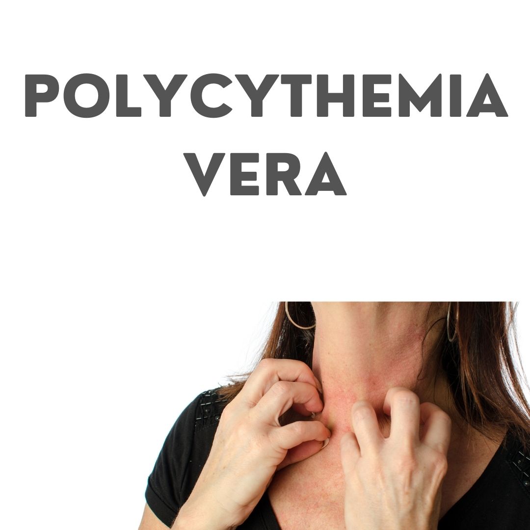 Polycythemia Vera