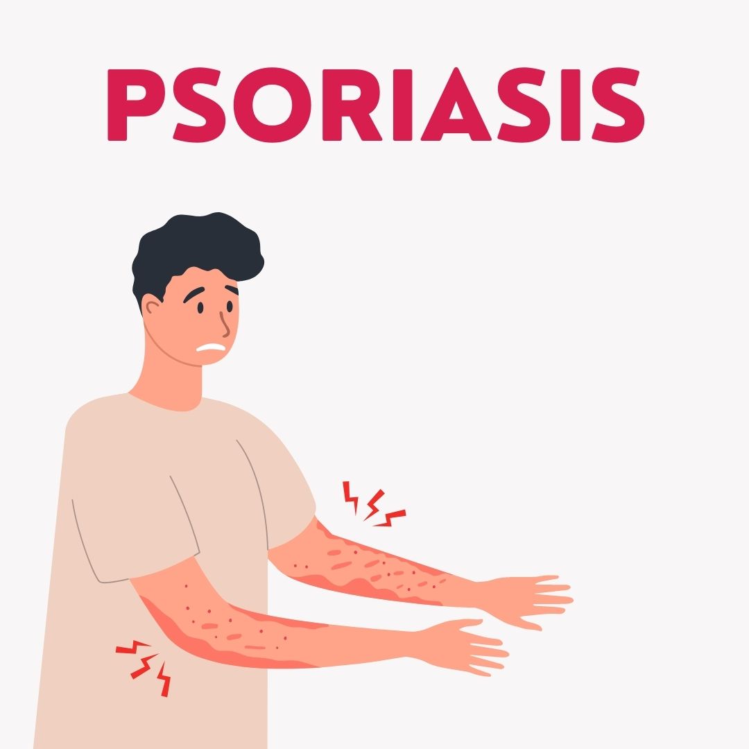 Psoriasis