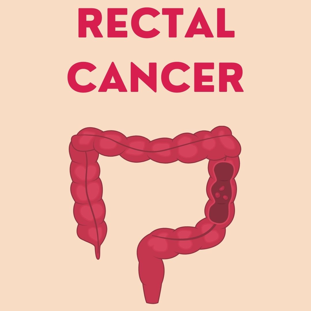 Rectal Cancer