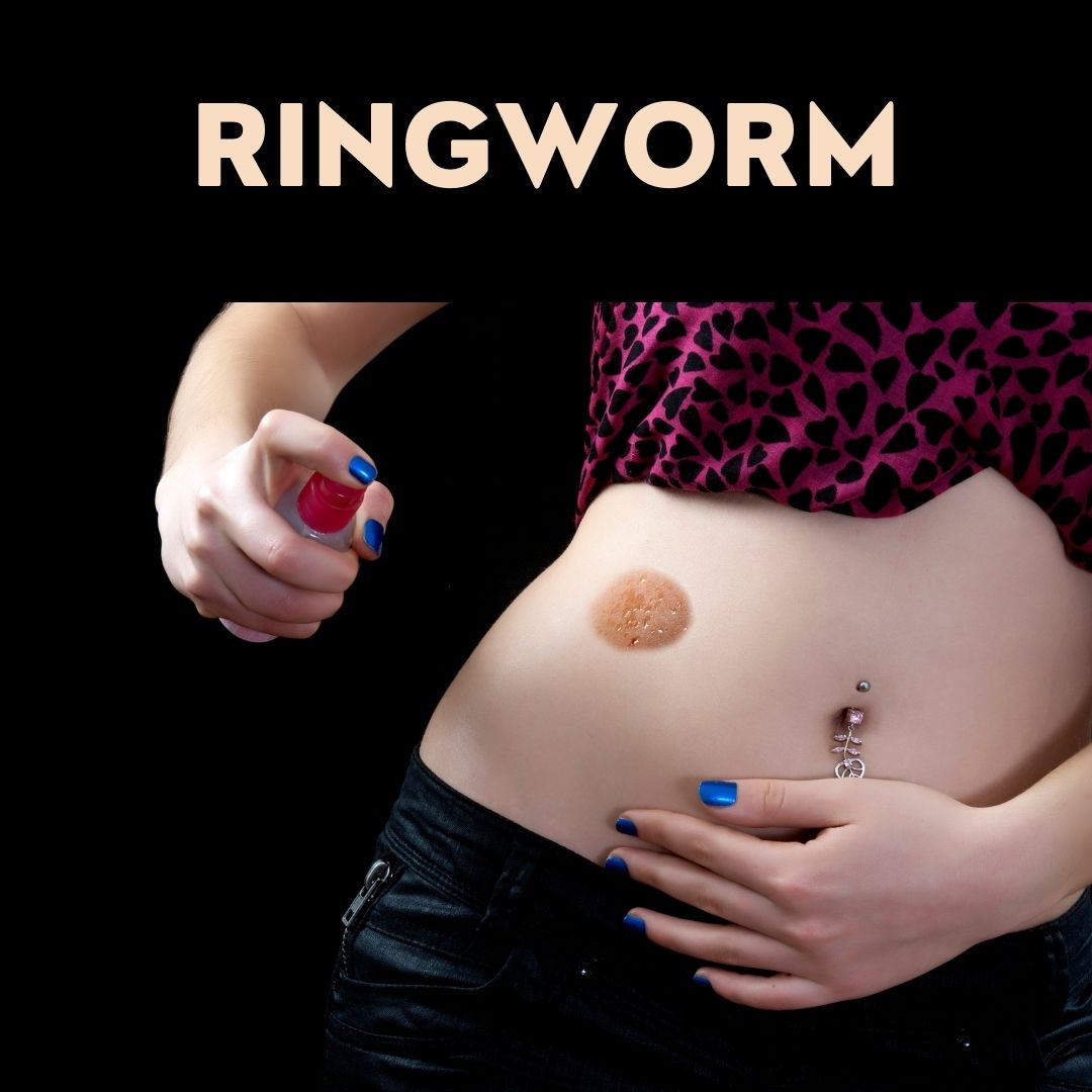 Ringworm