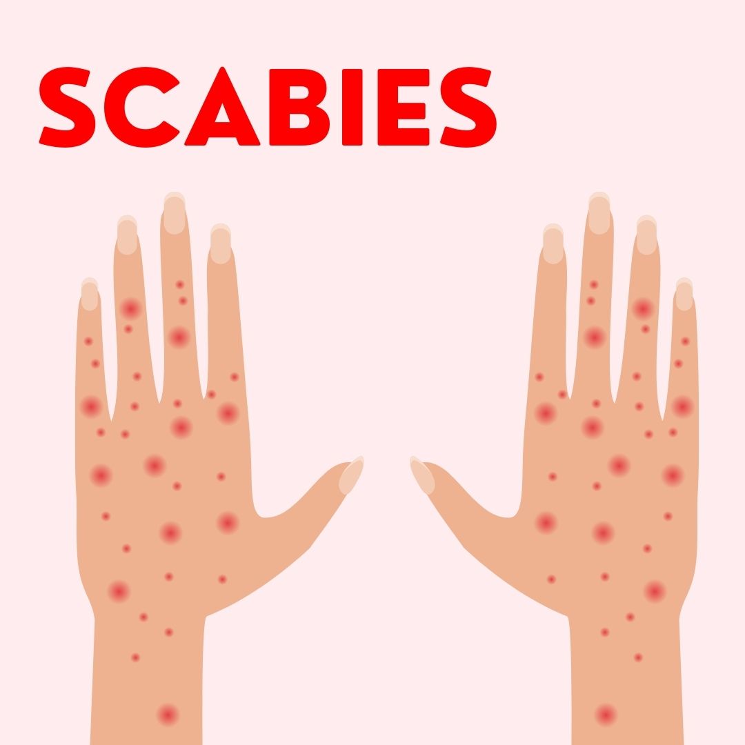 Scabies