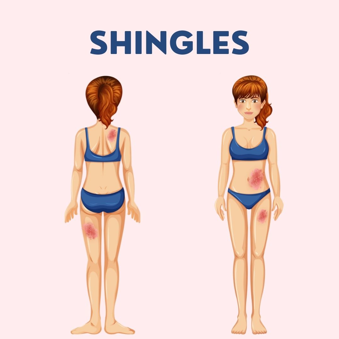 Shingles