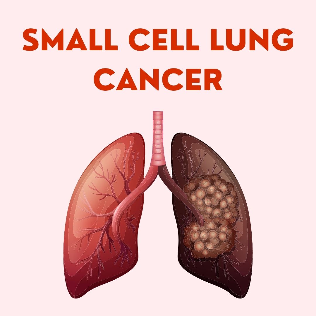 Small Cell Lung Cancer