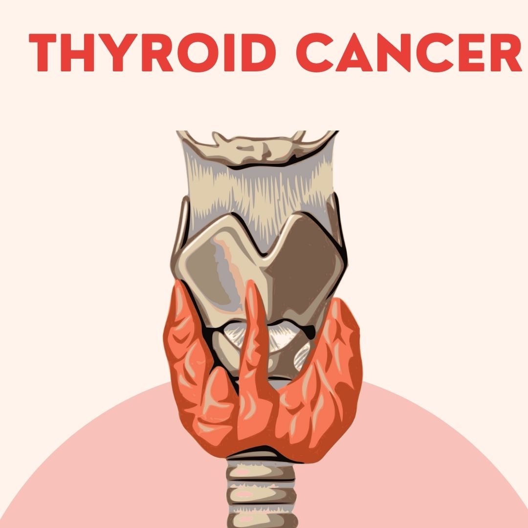 Thyroid Cancer