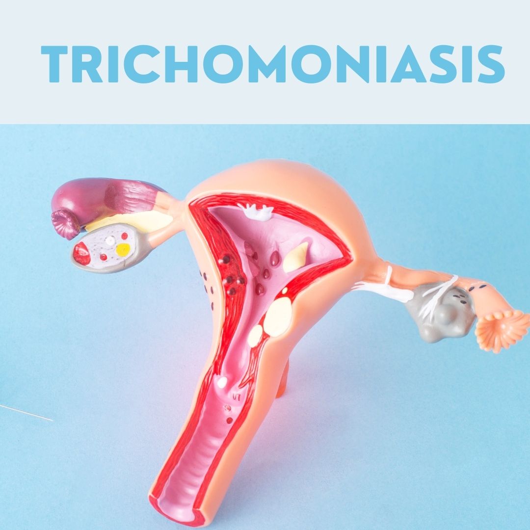 Trichomoniasis