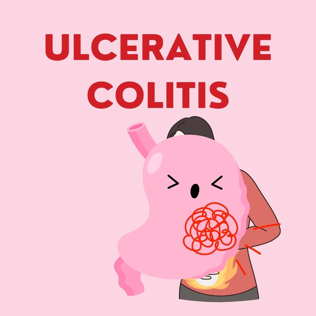 Ulcerative Colitis