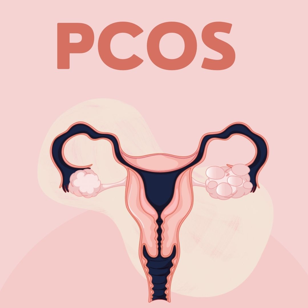 PCOS - Polycystic Ovaries
